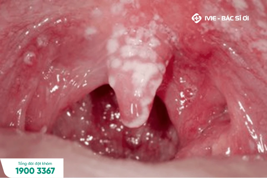 Dấu hiệu trẻ bị nấm miệng, lưỡi và cách chữa trị khỏi ngay lập tức