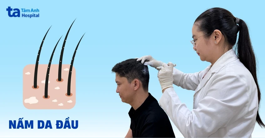 Hình ảnh nấm da đầu ở trẻ em và cách điều trị hiệu quả