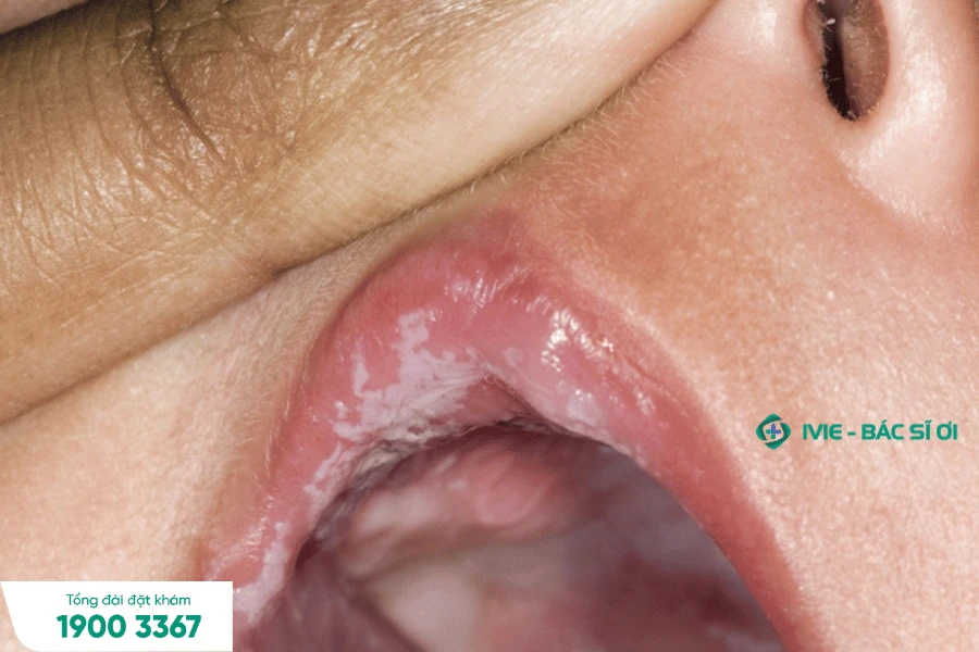 Hiểu biết về hình ảnh nấm lưỡi và tác động của nó