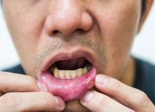 Hình ảnh nấm miệng HIV và tác động đến sức khỏe