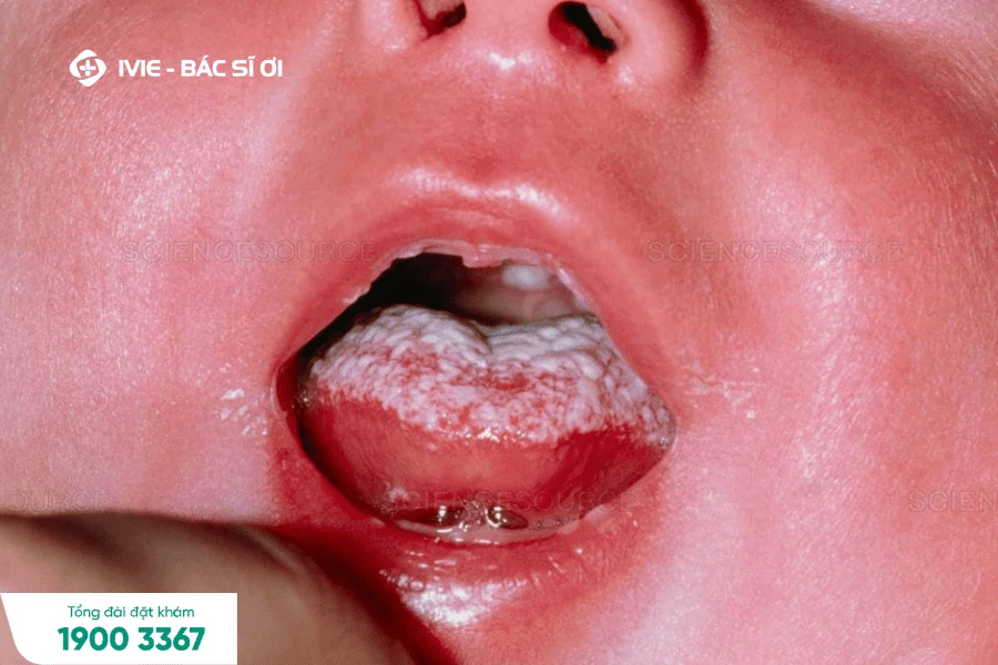 Dấu hiệu trẻ bị nấm miệng, lưỡi và cách chữa trị khỏi ngay lập tức
